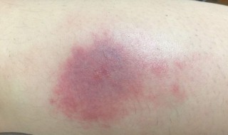 蚊子咬了红肿怎么止痒（蚊子咬后红肿痒怎么办）