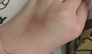 淤血怎么处理 手被挤了有淤血怎么处理