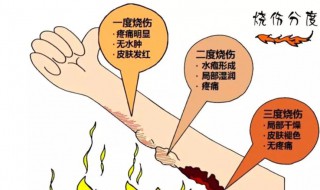 烧伤怎么处理好的快（烧伤怎么办）