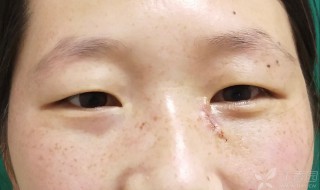 眼角有痣代表什么 眼角有痣代表什么意思