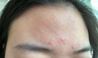 眉心长痘痘怎么调理 眉心长痘痘怎么调理小妙招