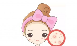暗疮和粉刺的区别是什么 暗疮和粉刺的区别是什么意思