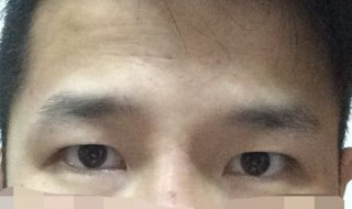 怎样去眼角纹 怎么才能去眼角纹