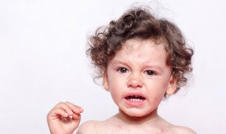 孩子头上长虱子怎么办 4岁孩子头上长虱子怎么办