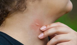 被蚊子咬后第二天起包吗 为什么蚊虫叮咬后第二天才起包