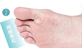 什么是鸡眼（什么是鸡眼的症状图片 处理方法）