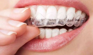 牙套适合年龄（牙套适合年龄范围）