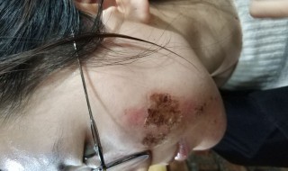 水痘坑的修复方法（水痘坑的修复方法图片）