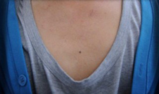 胸前有痣代表什么 男人胸前有痣代表什么