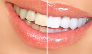 牙齿发黄怎么办 牙齿发黄怎么可以变白