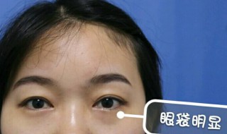 有什么祛眼袋的好方法 祛眼袋的几种方法
