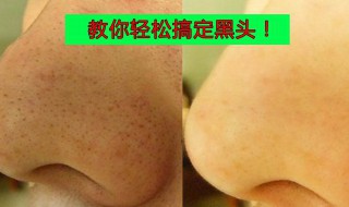 清理黑头最有效的方法 如何清理黑头最有效