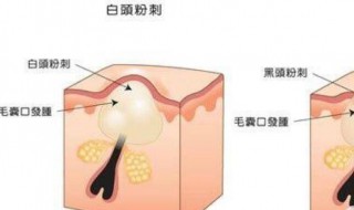 脸上粉刺闭口怎样消除 脸上粉刺闭口怎样消除小妙招