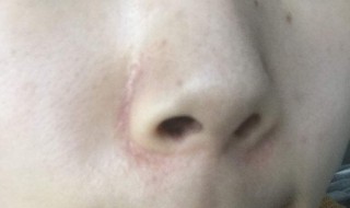 脸上有黑头怎么办（女孩脸上有黑头怎么办）