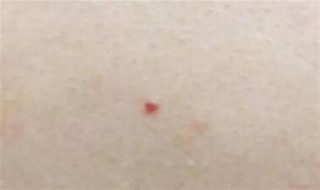 红痣代表什么 身上长红痣是什么问题
