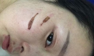 去疤去印的方法 去疤印最好的办法